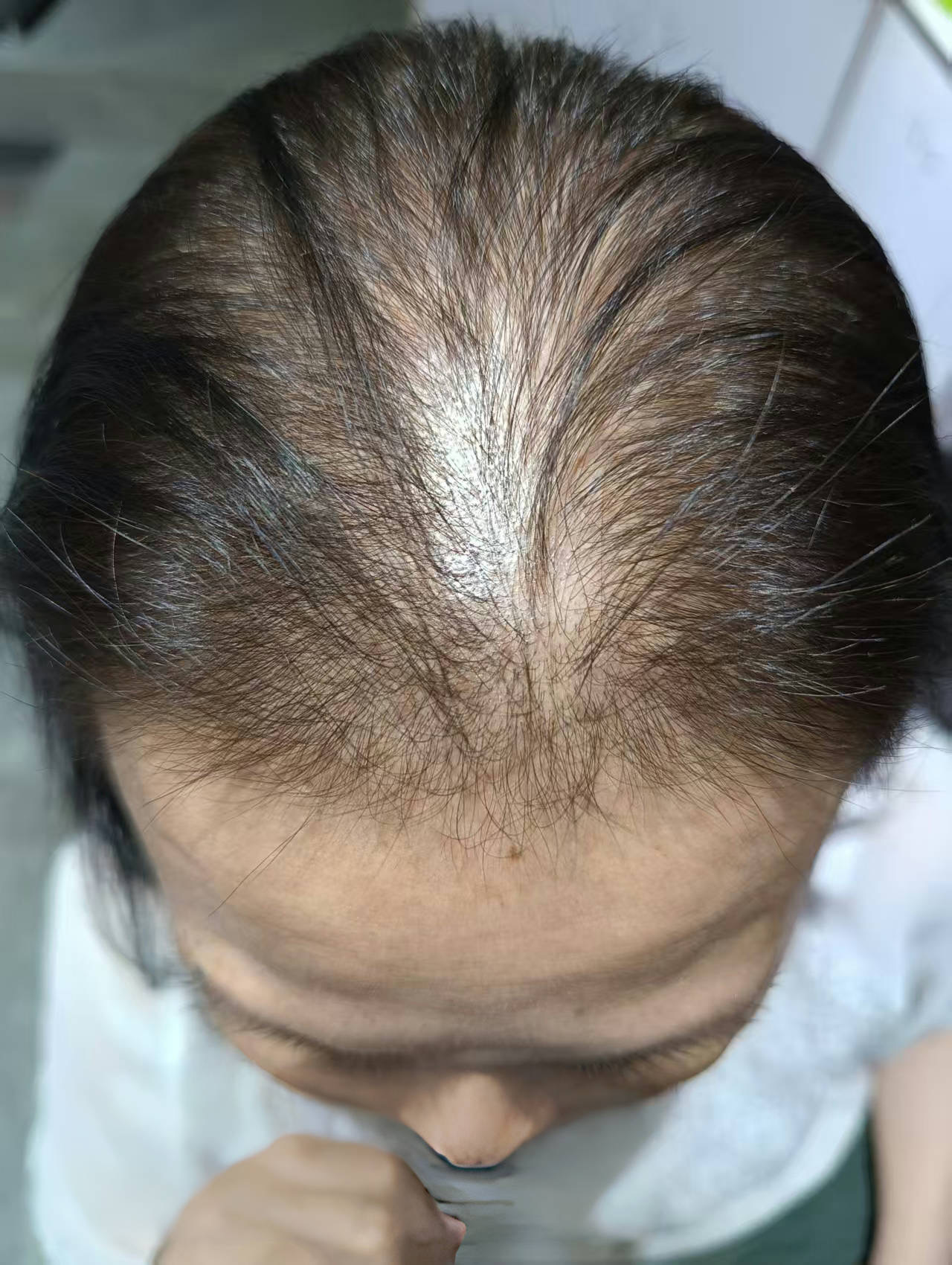 55岁女性用户养护前头顶状态记录