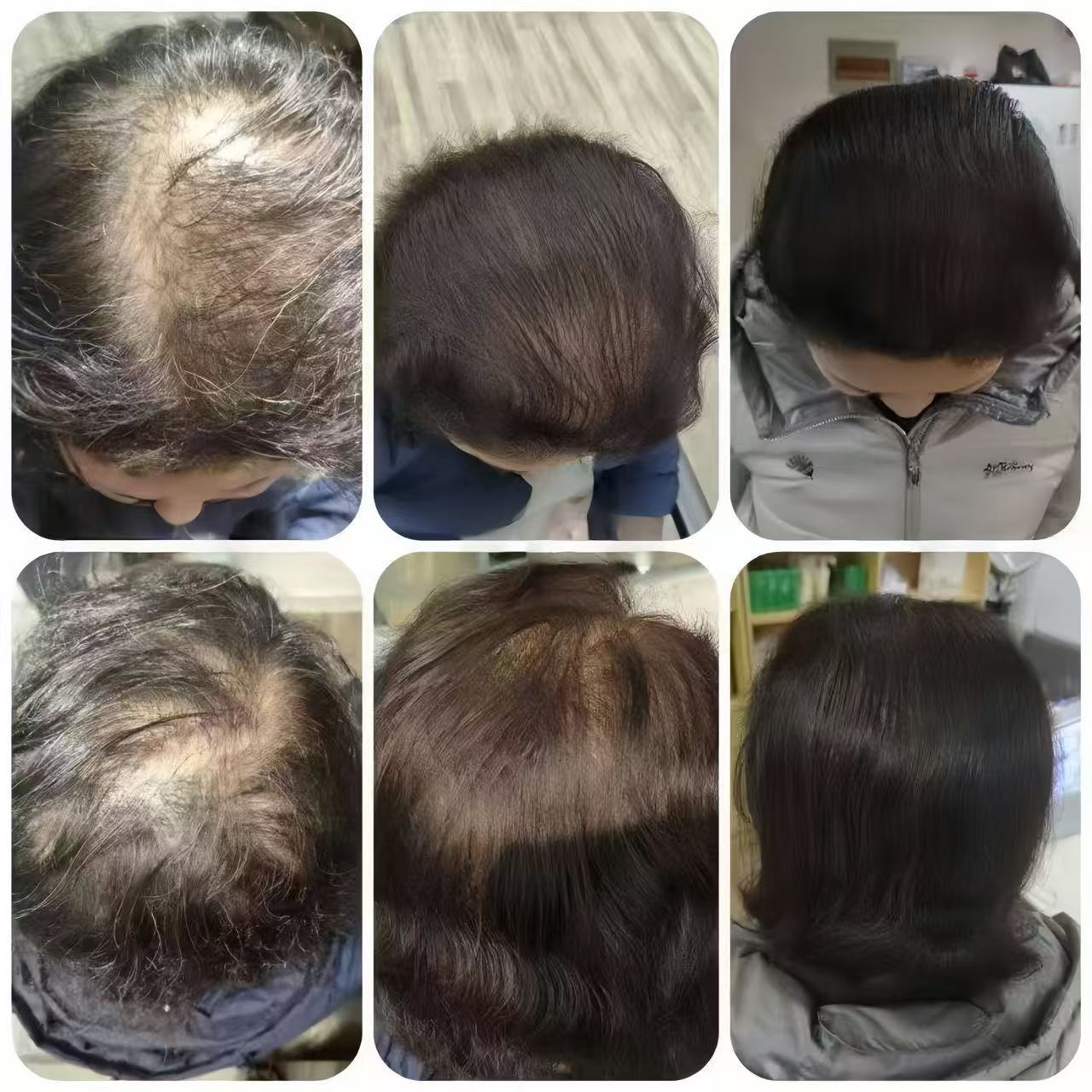 张女士养护前、5个月与13个月连续观察组合图